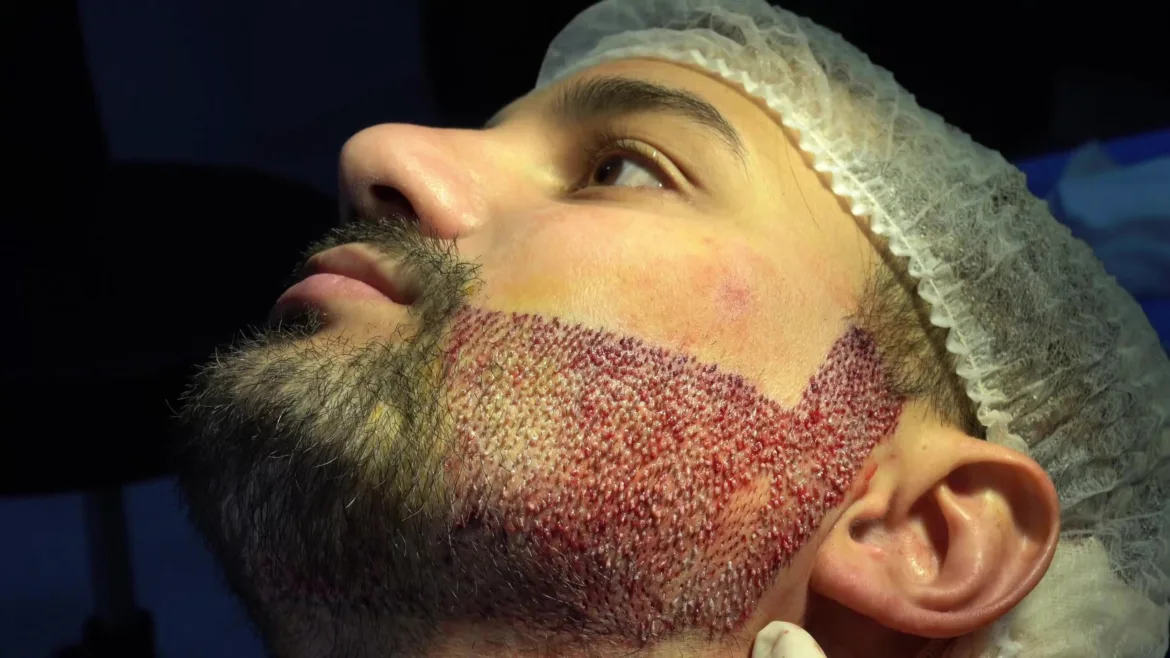 Facial Hair Transplant